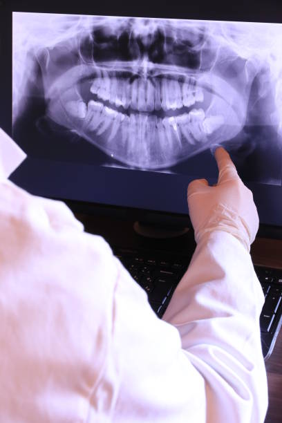 Best Emergency Wisdom Teeth Removal in Winnebago, IL
